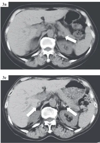 Fig. 3b Abdominal  CT  on  admission  showed  calci- calci-ﬁ cation and enlargement in the bilateral adrenal glands.