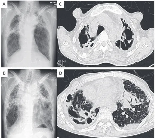 Fig. 1 (Case 7): Chest X ray (A) showed large cavitary lesions with ﬁ brosis in bilateral upper lobes  before treatment. Chest X ray (B) and CT (C, D) showed that bilateral cavitary lesions got worse and  consolidation revealed in the left lingular segment