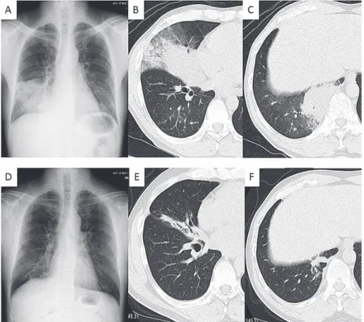 Fig. 2 (Case 8) : Chest X ray (A) and CT (B and C) showed consolidations in the right middle lobe  and lower lobe before treatment. Chest X ray (D) and CT (E and F) showed that these consolidations  improved after 12 months