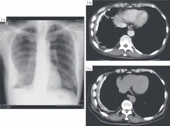 Fig. 1 Chest X-ray (1a) and computed tomography (CT) (1b) showed small amount of pleural effusion  surrounded by calciﬁ ed pleura. The chest CT ﬁ ndings had not changed from 5 years ago (1c).  Fig