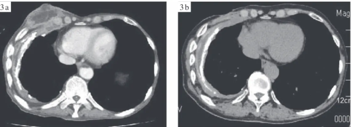Fig. 3 (3a)  Chest  CT  showed  increase  in  pleural  effusion,  and  a  middle  collection  of  ﬂ uid  in  the  musculature of the right chest, which was consistent with empyema necessitates, in which pus can escape  toward chest wall.  (3b) Chest CT aft