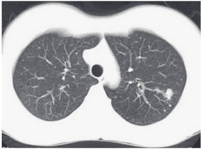 Fig. 2 Preoperative  chest  computed  tomographic  (CT)  scans  of  case  4.  Chest  CT  scans  showing  cavitary  lesion  in the upper lobe of the left lung.