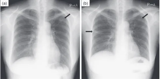 Fig. 2 Chest  X-ray  images  5  months  before  (a)  and  at  the  time  of  admission  (b).    (a)  showed  trabecular shadow in the upper ﬁ eld of the left lung.  (b) showed patchy shadows in the middle ﬁ eld  of the right lung and small granular shadows