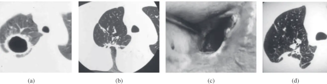 Fig. 1 Cavernostomy for multi-drug-resistant tuberculosis.  (a) CT findings before surgery.  (b), (c) treatment by drainage gauze.  (d) wound closure after purification.(a)(b)(c) (d)12）  宮本 忍：肺切除術