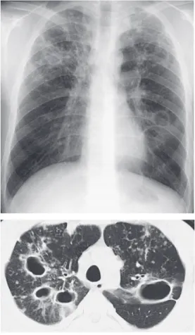 図 5 診断時の胸部 X 線とCT（症例 3 ） 【症例2】23歳ミャンマー人女性，技術者として働くことを目的に来日した。来日直後の健診で胸部異常影が指摘され，活動性結核（rⅢ1，薬剤全感受性）と診断された。2カ月前にミャンマーで撮影された健康診断時の写真を取り寄せると，同じ部位に同様の影が指摘できたが，診断書には「活動性病変なし」と記載されていた。同様な経過で診断に至った27歳ミャンマー人の男性は多剤耐性結核であった。彼はデラマニド73万円⁄月（患者負担5 %：4万円弱）の18カ月の長期投与を要した。 こ