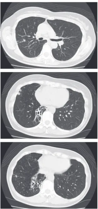 Fig. Preoperative chest computed tomographic (CT) scans  of case 5. Chest CT scans showing nodular opacities in the  upper and middle lobes and bronchiectasis in the lower lobe.  るのが現状であると思われる。当院では，投薬期間に関しては，術前は「外科治療の指針」に準じ最低3 カ月間，術後は，術中摘出組織の菌培養が陰性であったものは1