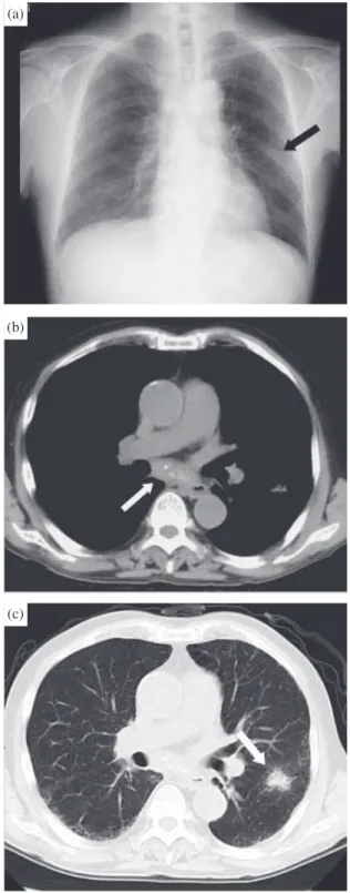 Fig. 3 Gallium ( 67 Ga) scintigraphy showing abnormal  accumulation in the mediastinal region.(a)(b)(c)考   察 本症例は，HIV感染のないMDS患者に発生した播種性MAC症であり，フェリチン値が著増し骨髄検査で血球貪食像を認めたことから，血球貪食症候群が合併して