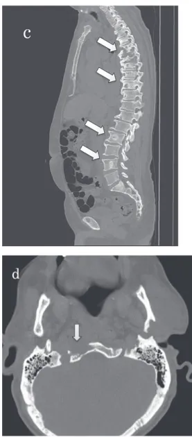 Fig. 3  Chest-abdominal  CT  showed  multiple  osteolytic lesions on the sternum (a), the right iliac  bone (b), vertebral bodies (c). Brain CT showed an  osteolytic lesion on the sphenoid bone (d).  併するが，臓器移植後状態，慢性腎不全などに合併した DNTM 症の報告も散見される 1) 2) 。またこのような