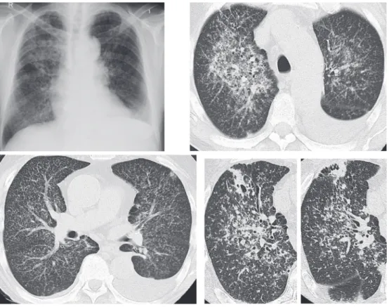 Table Laboratory findings on admission Fig. 1 Chest X-ray and chest computed tomography on admission. Miliary shadow and left pleural effusion was seen. High Resolution CT also shown (right below)