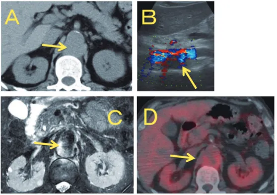 Fig. 2  Abdominal aorta aneurysm was suspected (arrow) in the abdominal CT (A), US (B),  MRI (C), and PET-CT (D). It was shown with hypo echoic shadow in (B), enhanced in (C),  and enhanced with ring like shadow (D).熱も37℃前半に解熱，CRP（3.18 mg/dLから 0.65 mg/dLへ）
