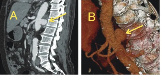 Fig. 3 Enhanced abdominal CT (A) and 3D model of aneurysm (B) (arrow).  Fig. 4 A. Necrosis (black arrow) and granuloma around the necrosis (yellow arrow) in the aneurysm  (×40). B. Non caseous necrosis in the lymph node (×40). C, D, and E, fast acid bacter