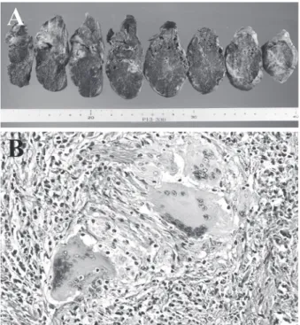 Table 2 Reported cases of Mycobacterium kansasii presenting a lung nodular shadowFig. 2 Histopathological findings.A. Macroscopic findings of the resected specimen. The size of tumor was 4×2 cm, and it was located just beneath the pleura.B. Microscopic fin