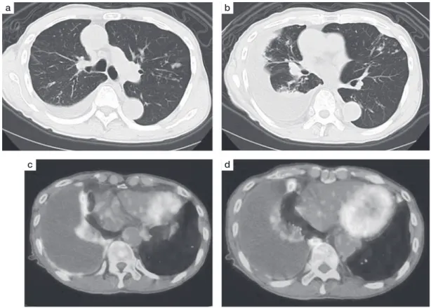 Fig. 2 CT and FDG-PET/CT showed pleural thickenings and FDG uptakes along the right pleura. 