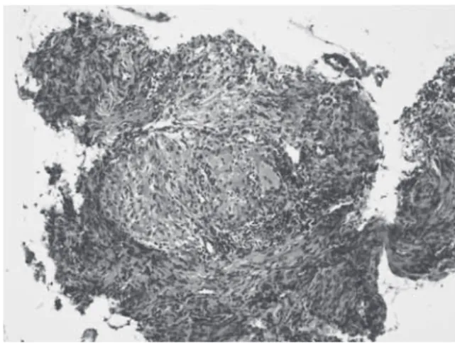 Fig. 3 Histological features of transbronchial lung biopsy  specimen Granulomatous inﬂ ammation was surrounded by ﬁ brosis.Fig