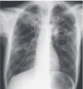 Fig. 1 Chest roentgenogram on admission of case 1 reveal- 1 Chest roentgenogram on admission of case 1 reveal-ed infiltrate shadows in bilateral upper lung fields.