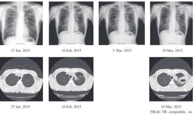 Fig. 1 Clinical course of a TB (tuberculosis) patient with paradoxical response during successful anti-tuberculosis therapy                        TBLB: transbronchial lung biopsy27 Jan. 201527 Jan. 2015 16 Feb. 201516 Feb. 2015 3  Mar. 2015 10 Mar. 201510