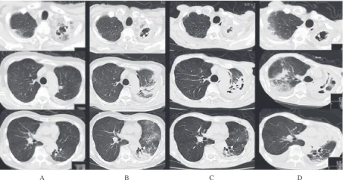 Fig. 2 Chest radiography in April 2008 at diagnosis of nontuberculous mycobacterial  lung disease (A) and in February 2011 on admission (B).  Fig