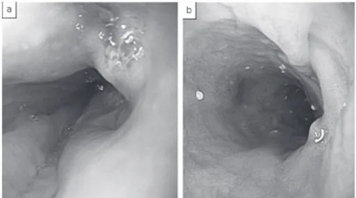 Fig. 2 (a) Before anti-tuberculosis therapy, gastroendoscopy revealed the ulcerative lesion on the  middle esophagus.  (b) After treatment, ulcerative lesion and narrowing were improved.