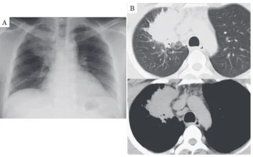 Fig. 1 Chest X-ray (A) and chest computed tomography (CT; B) on first visit showing  tumor-like mass shadow in right upper lung without any acinar lesion. CT also shows  mediastinum lymphadenopathy