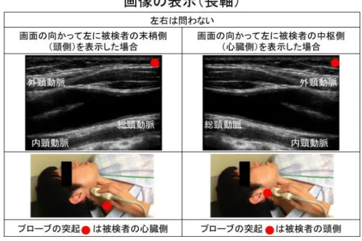 図 9-b：頸動脈断層像の表示方法（長軸断面）  2）カラードプラ法（図 1 0 ）  カラードプラ法の表示色相は，原則的にはプローブに向かう血流を赤色（暖色系） ，遠ざかる血流を青色（寒色系） とする．ただし，記録画像にカラーバーを表示すればその限りではない．  図 10：カラードプラ法の血流シグナルの表示  3 ）パルスドプラ法（図 1 1 ）  ドプラ血流波形の基線に対する血流方向の表示は，プローブに向かう血流を基線より上方（正の方向） ，遠ざかる 血流を基線より下方（負の方向）に表示する．ただし，血
