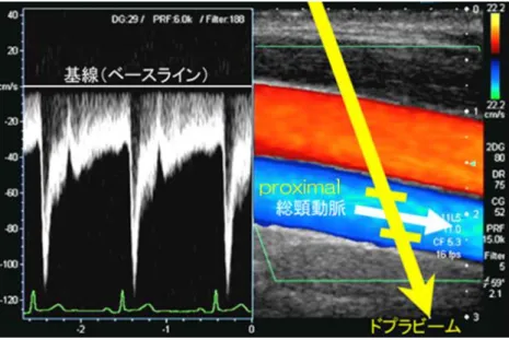 図 11：パルスドプラ法の血流波形の表示  4.3 画像の条件設定  1）エコーゲイン  血管内腔に近い低輝度病変を見落とすことのないように，ややゲインを上げて観察する．ただし，画像記録の際 は，病変部のエコー性状が評価可能なエコーゲインに調整する．  2）フォーカスポイント  現行の装置の多くはフォーカスを複数設定することが可能で，深度方向に広範囲に良好な画像を得る利点を有す るが，フレームレートが低下する欠点がある．フレームレートの低下は，頸動脈拍動に伴う血管運動に加え，並走 する静脈径変化や呼吸に伴う