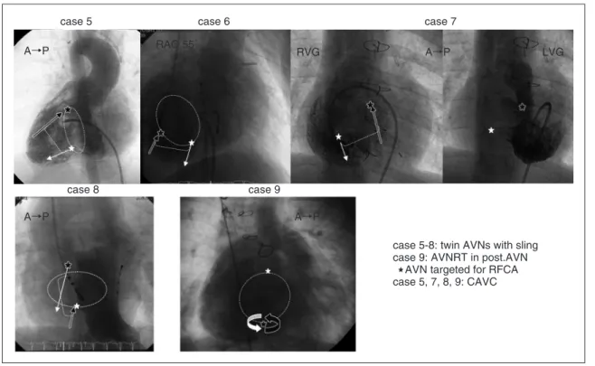 Fig. 3  Schema of re-entrant pathway of tachycardia in each case with twin AVNs. 