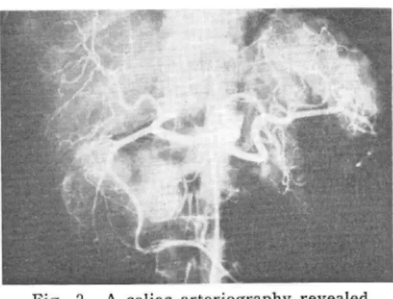 Fig.  3  A  celiac  arteriography  revealed a  round,  hypervascular  tumor located  in  the  head  of  the  pancreas.