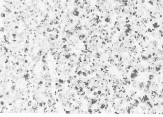 Fig.  5  Microscopic  findings  showing many  tumor  cells  with  abundant granules  immunostained  for  calcitonin.