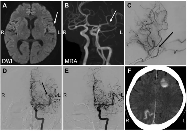 Fig. 1 Neuroradiological findings of case 1.
