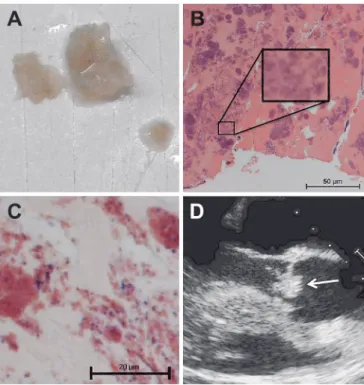 Fig. 2 Images of the thrombi and transesophageal echocardiography (TEE) of case 1.