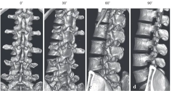 Fig. 1  Three dimensional computed tomography （CT）of the left lumbar intervertebral foramen in a  healthy adult
