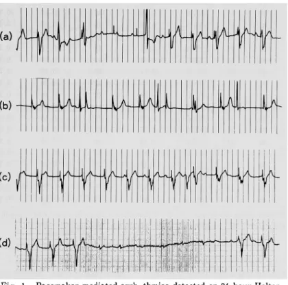 Fig.  1  .  Pacemaker  mediated  arrhythmias  detected  on  24-hour  Holter   recordings  in  patients  with  VVI  pacing