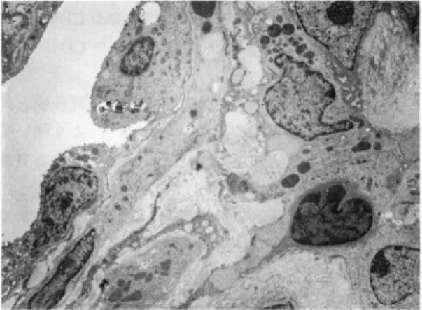 Fig.  4b  Electron  micrograph  showing  a  giant  cell containing  virus-like  particles