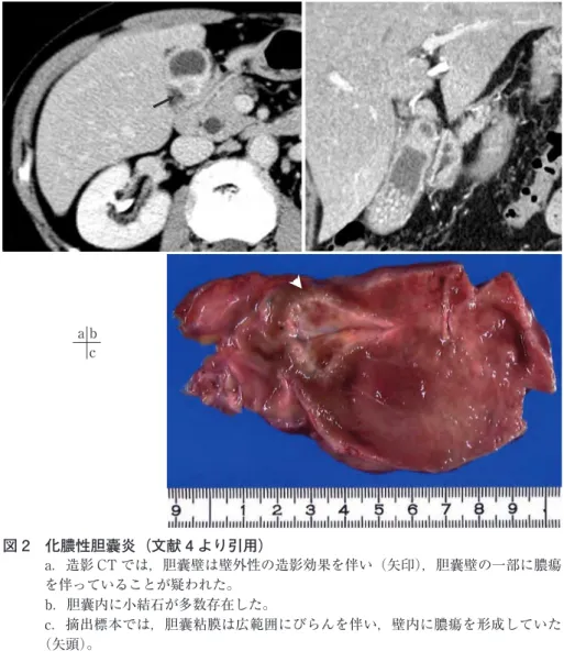 図 2　化膿性胆囊炎（文献 4 より引用） a．造影 CT では，胆囊壁は壁外性の造影効果を伴い（矢印），胆囊壁の一部に膿瘍 を伴っていることが疑われた。 b．胆囊内に小結石が多数存在した。 c．摘出標本では，胆囊粘膜は広範囲にびらんを伴い，壁内に膿瘍を形成していた （矢頭）。a bc