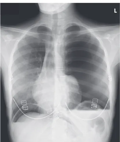 Fig. 1.    A chest X-ray showed a massive air collection in the left  thoracic cavity with displacement of the mediastinum to the right.