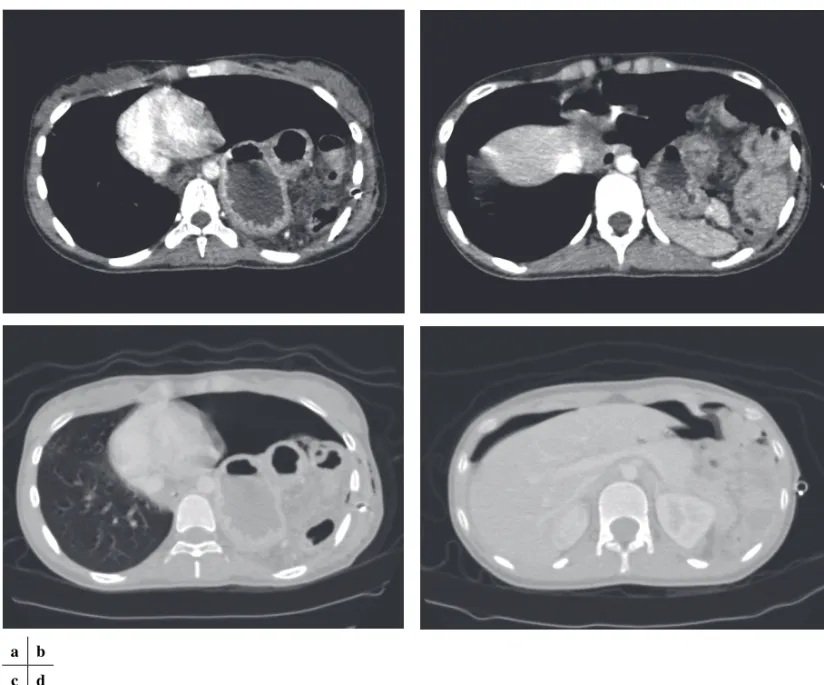 Fig. 2.    Enhanced computed tomography revealed a prolapse of the stomach, transverse colon and spleen into the left thoracic cavity (a / b),  and a collection of air in both the abdominal and left thoracic cavities, with displacement of the mediastinum t