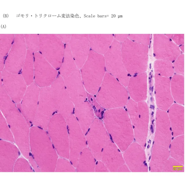 図 1   OPDM の代表的病理像 