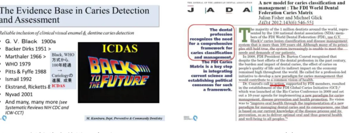 図 1  齲蝕診査基準の変遷                図 2  JADA 2012; 143(6): 546-551  ( A new model for caries classification management: The FDI  World Dental Federation Caries Matrix, J Fisher, M