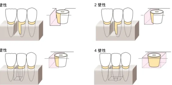 図 2.5-5  壁数による垂直性骨欠損の分類 (2)  歯周炎の治療法と問題点 歯周炎の治療では、歯周基本治療がすべての患者に第一に行われる。歯周基本治療は、 歯周炎の原因を除去する基本的な治療であり、プラークコントロール、プラーク停滞因 子の除去等の口腔環境の改善、スケーリング・ルートプレーニング等で構成される。ま た、咬合性外傷を合併する場合には咬合調整や暫間固定等の咬合治療が行われる。歯周 基本治療により歯肉の炎症が軽減し PPD は減少するが、依然としてプロービング時の歯 肉出血があり、 PPD 