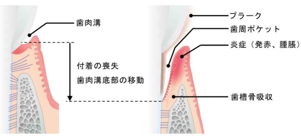 図 2.5-3  健康な歯周組織（左）と歯周炎（右） (2)  歯周炎の疫学 平成 23 年歯科疾患実態調査の結果、本邦の深さ 4 mm 以上の歯周ポケットを持つ者の 割合は約 34% であり、潜在的な歯周炎罹患者数は約 4300 万人と推定される 2) 。潜在患者 の割合は、若年層で低く加齢とともに上昇し、 15 歳～ 19 歳で約 5% 、 30 歳～ 34 歳で約 20% 、 65 歳～ 69 歳で約 50% であり、 70 歳以降は調査対象歯の喪失により減少する 2) 。歯 周病の治療を受けている患