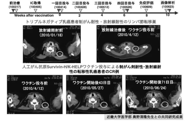 図 9 Survivin H/ HELP がんワクチン治療による転移性乳癌細胞の消失 Survivin H/ HELP がんワクチン投与によって，制がん剤耐性・放射線耐性のトリプルネガティブ乳がん患者のリンパ節転移 がん細胞が CT 画像上消失したことが確認された．近畿大学，外科，奥野教授との共同研究． の制癌剤，放射線耐性，頸部転移癌が CT 画像上消 失する CR 1 例，および癌の増殖が抑えられた SD 1 例も観察された（図 9）．この結果を受けて，筆者 らは，厚生労働省の創薬基盤研究推進事