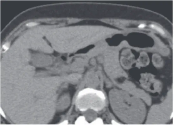 図 3  単純CT検査 膵尾部に境界明瞭な低吸収 域を認めた。 図 4  T2強調画像（MRI） 膵尾部に高信号 域を認めた。 図 5  T2 強 調 画 像（MRI）  腫 瘤 部 は T2 Fatsat画像にて脂肪抑制された。 図 6  T1強調画像（in  phase）（MRI） 膵尾部 に高信号域を認めた。 図 7  T1強調画像（out  phase）（MRI） 腫瘤部は脂肪抑制された。