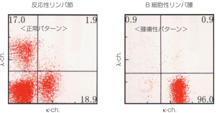図 4.  kappa鎖（FI TC標識抗体：横軸）と l ambda鎖（phycoer yt hr i n 標識抗体：縦軸）のフローサイトメトリーの結果（二次元展開図）．反応性 リンパ節（a）では kappa ＋ 細胞が若干多いものの基本的には両者が混在し ているが，B細胞性リンパ腫（b）では明らかかつほぼ完全に kappa鎖側 にシフトしている［＝反応性パターンで存在する l ambda鎖群があるべき ところ（＝水色の点線部）にドットの集中が無い］ため abnor mal cel l popul at 