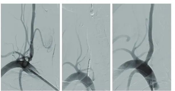 Figure 3  Deployment of the Palmaz Genesis under distal balloon protection resulted in a remarkable improvement of the  vertebral artery origin stenosis.