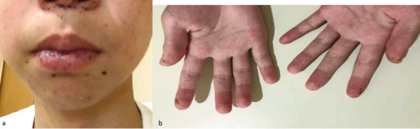 Fig. 3. Peutz-Jeghers 症候群における色素斑（a:口唇，b:指尖・指腹）