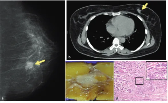 Fig. 4. 多発結節性甲状腺腫 a. CT 画像. 甲状腺右葉に大きさ約 20mm，境界が比較的明瞭な腫瘤様病変を認める． b. CT 画像. CT MRP 画像では，腫瘤の内部に不均一性を認める． c