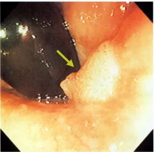 Figure  2  Close  up  view  of  polyp  showing  reddish  lines  with  various  length.