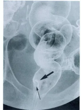 Figure  6  Resected  specimen  of  anal  canal  containing  elevated  lesion  (arrowed).
