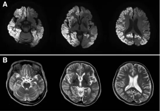 図 1. V180I 遺伝性 CJD 自験例の頭部 MRI 所見(発症 8 ヵ月後。A;  拡散強調像、B; T2 強調像)    拡散強調像では、大脳皮質に輝度が高い高信号を広範に認める。 T2 強調像では、拡散強調像の 高信号に一致して大脳皮質の高信号と腫脹像を認める。