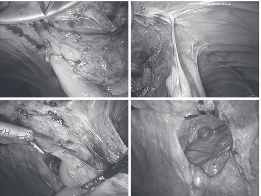 Fig. 4　左上：エンドクローズを用いて固定糸を牽引． 右上：挙上結腸周囲固定の拡大写真． 左下：